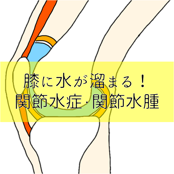 膝に水が溜まる 関節水症 関節水腫 の原因からリハビリまで解説 白衣のドカタ